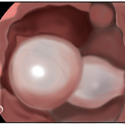 Facet joint cyst